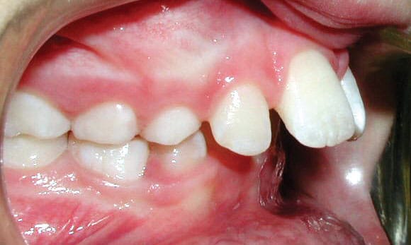 Close-up example of upper front teeth protrusion before orthodontic treatment at Bernhardt & Smith Orthodontics, Bishop Drive Office and 50th Street Office in West Des Moines, IA